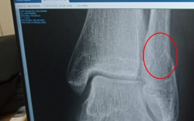 I Broke My Ankle